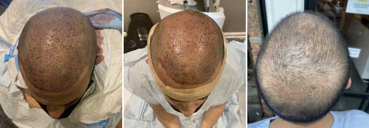 Benefits of Having a Hair Transplant in New York