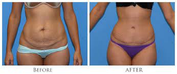 Find Out What’s Involved with Abdominoplasty Surgery in Miami